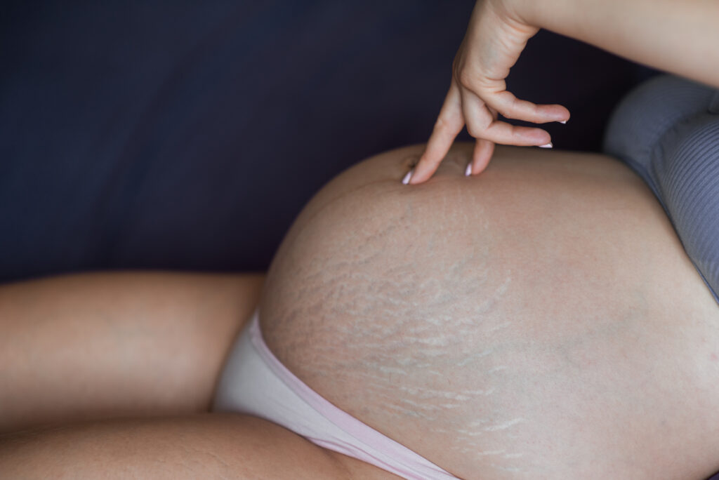 Zrelé biele strie na bruchu tehotnej ženy – striae albae